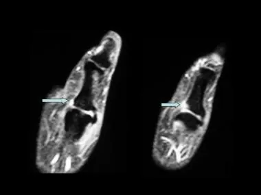 MRI Left Thumb